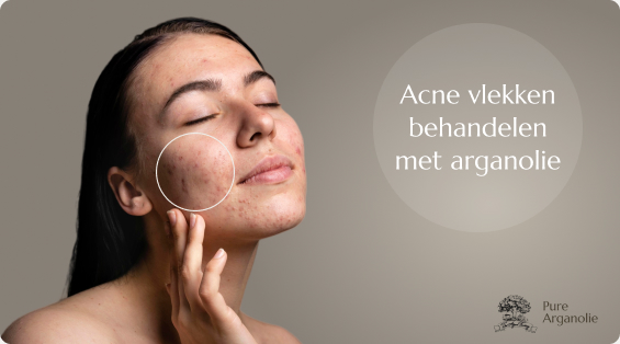 Acne behandelen met arganolie